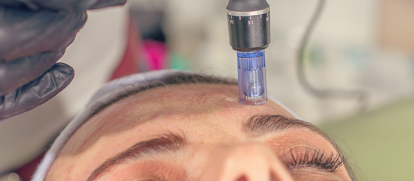 Microneedling